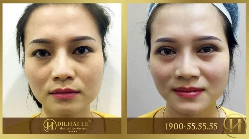 Lấy lại gương mặt tươi trẻ sau khi cắt mí 5D