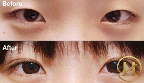 Mắt xếch hoàn toàn có thể cắt mí mắt để đôi mắt to tròn hơn