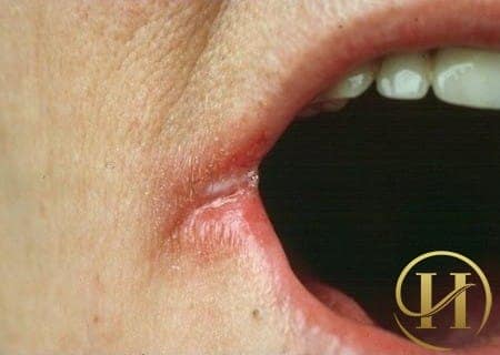 Nếu mép môi bạn bị nứt nẻ thì vùng miệng của bạn đang bị nhiễm trùng