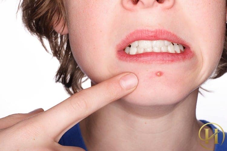 Mụn đinh râu rất nguy hiểm không được tụ ý nặn mụn