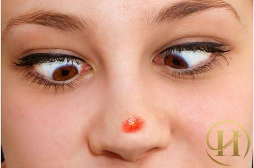 Mụn mọc trên mũi thể hiện tim của bạn đang gặp vẫn đề
