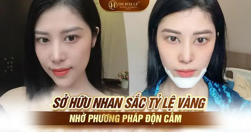 Sở hữu nhan sắc tỷ lệ vàng nhờ phương pháp độn cằm