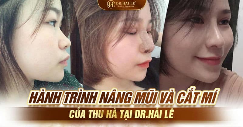 Hành trình nâng mũi và cắt mí của Thu Hà tại Dr.Hải Lê Hành trình nâng mũi và cắt mí của Thu Hà tại Dr.Hải Lê
