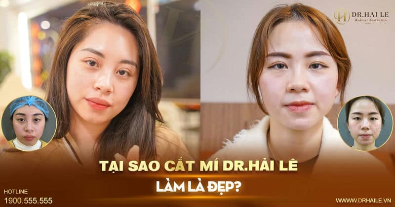 Tại sao cắt mí Dr.Hải Lê làm là đẹp?