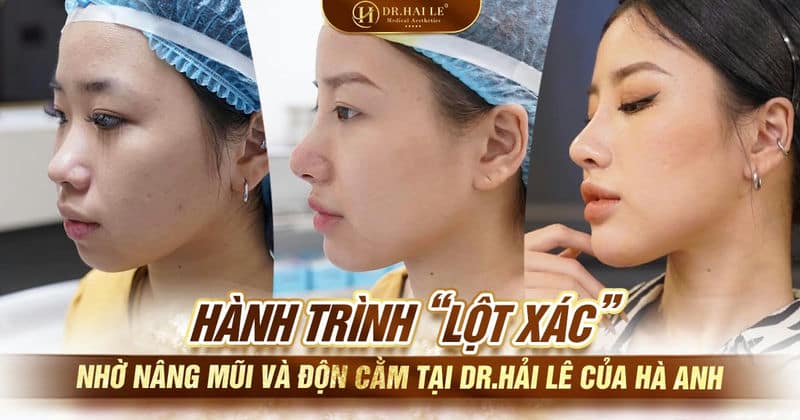 Hành trình “lột xác” nhờ nâng mũi và độn cằm tại Dr.Hải Lê của Hà Anh