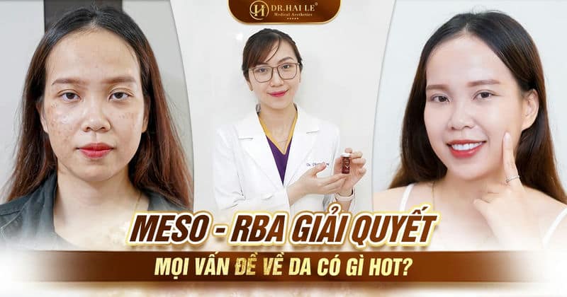 Meso - RBA giải quyết mọi vấn đề về da có gì hot?