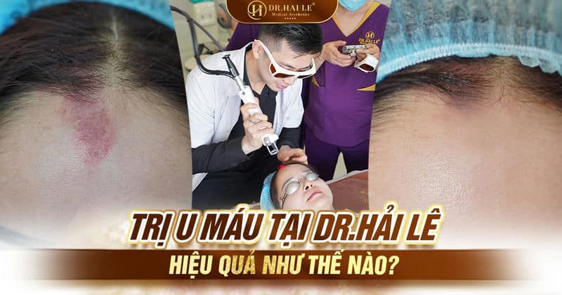 Trị u máu tại Dr.Hải Lê hiệu quả như thế nào?