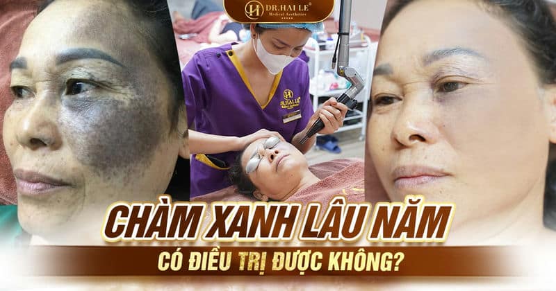 Chàm xanh lâu năm có điều trị được không?