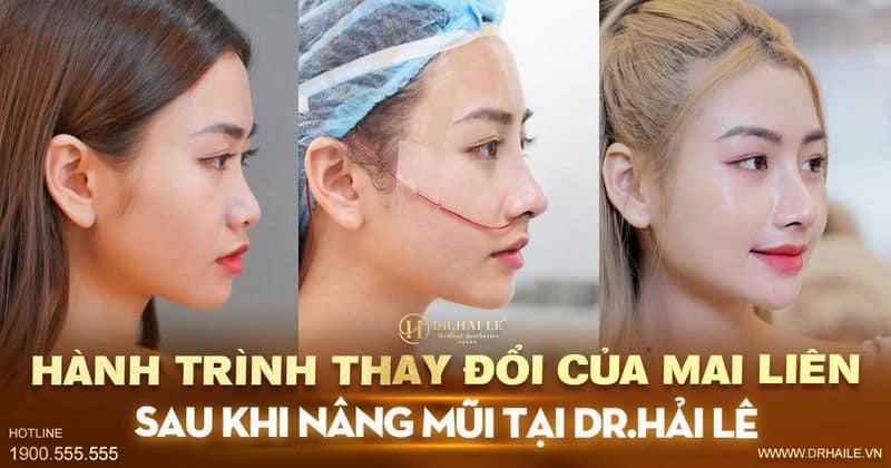 Hành trình thay đổi của Mai Liên sau khi nâng mũi tại Dr.Hải Lê Hành trình thay đổi của Mai Liên sau khi nâng mũi tại Dr.Hải Lê