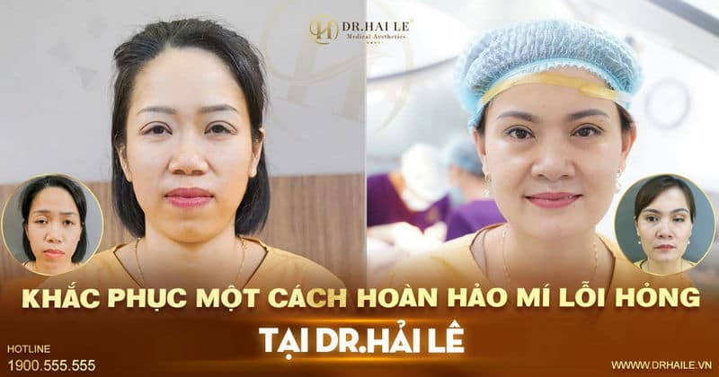 Khắc phục một cách hoàn hảo mí lỗi hỏng tại Dr.Hải Lê