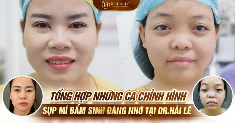 Tổng hợp những ca chỉnh hình sụp mí bẩm sinh đáng nhớ tại Dr.Hải Lê
