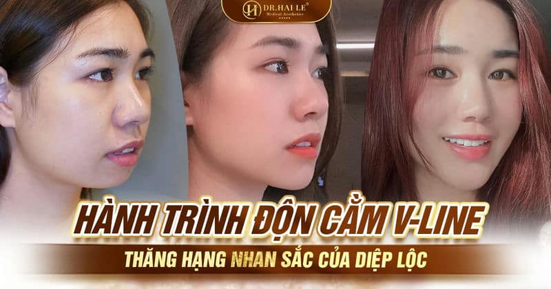Hành trình độn cằm V-line thăng hạng nhan sắc của Diệp Lộc Hành trình độn cằm V-line thăng hạng nhan sắc của Diệp Lộc