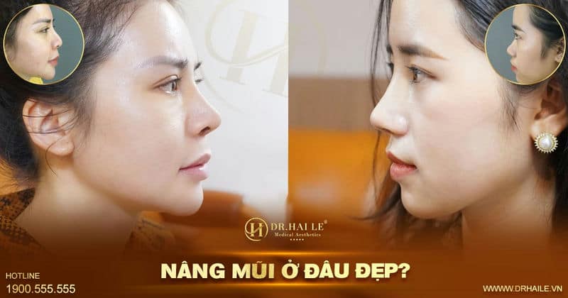 Nâng mũi ở đâu đẹp?