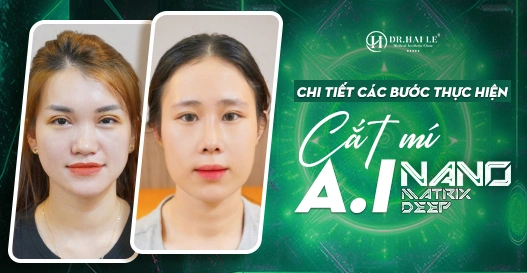 Chi tiết các bước thực hiện cắt mí A.I - Nano Matrix Deep