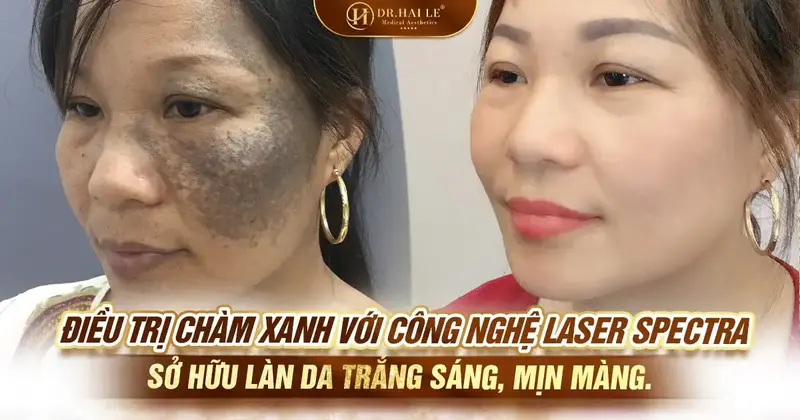 Điều trị chàm xanh với công nghệ Laser Spectra – Sở hữu làn da trắng sáng, mịn màng