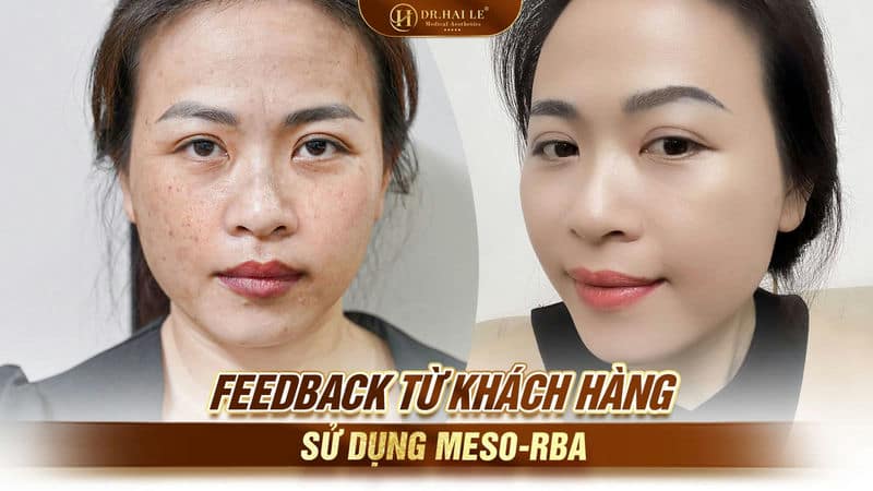 Feedback từ khách hàng sử dụng Meso-RBA