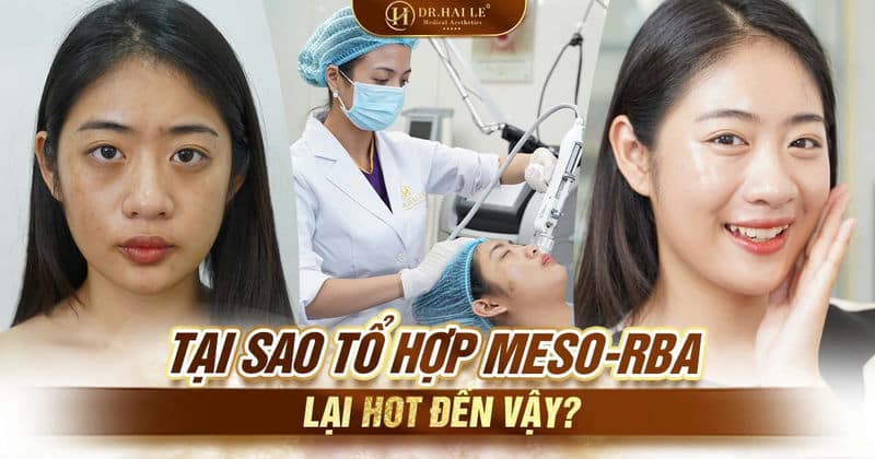 Tại sao tổ hợp Meso-RBA lại hot đến vậy?