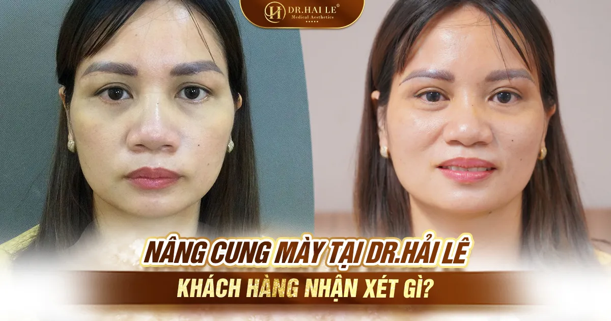 Nâng cung mày tại Dr.Hải Lê - Khách hàng nhận xét gì?