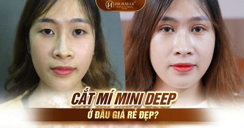 Cắt mí Mini Deep ở đâu giá rẻ đẹp?