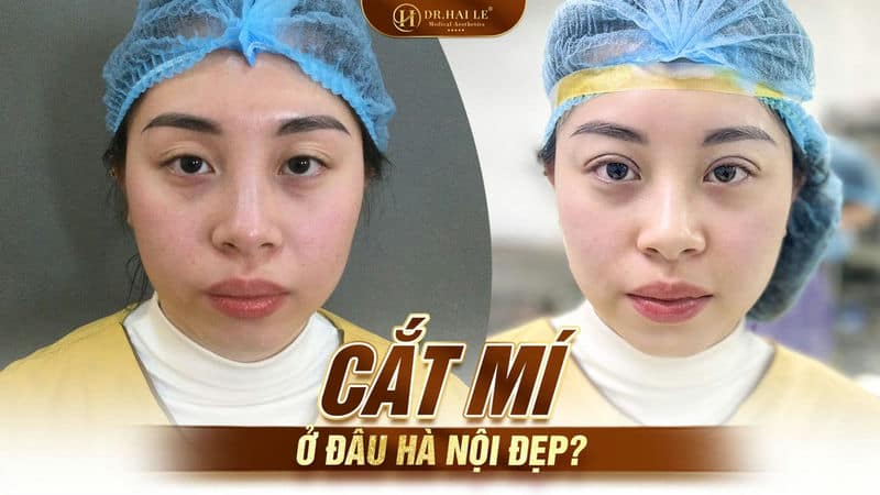 Cắt mí ở đâu Hà Nội đẹp?