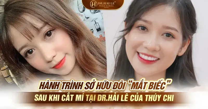 Hành trình sở hữu đôi “mắt biếc” sau khi cắt mí tại Dr.Hải Lê của Thúy Chi