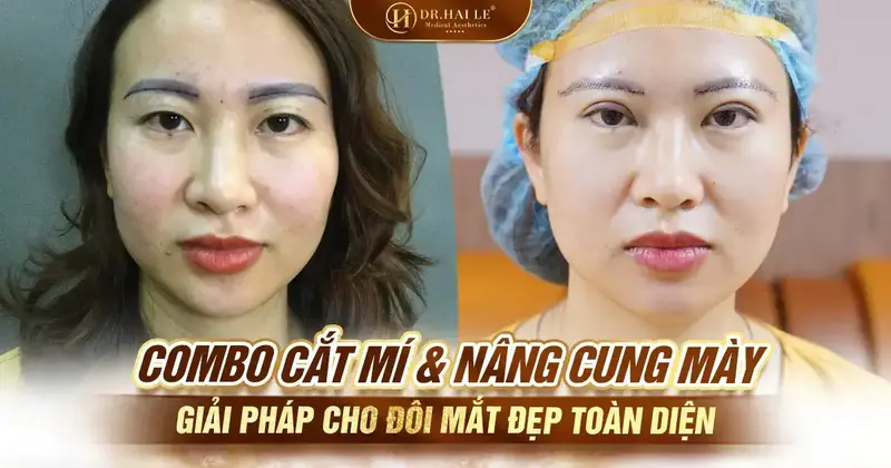 Combo Cắt mí & Nâng cung mày – Giải pháp cho đôi mắt đẹp toàn diện