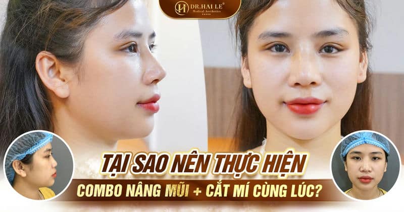 Tại sao nên thực hiện combo nâng mũi + cắt mí cùng lúc?