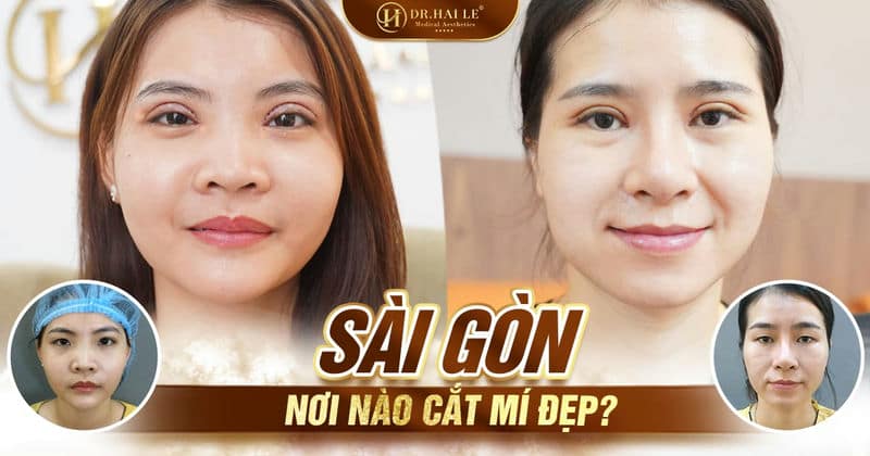 Thực hiện cắt mí ở đâu đẹp?