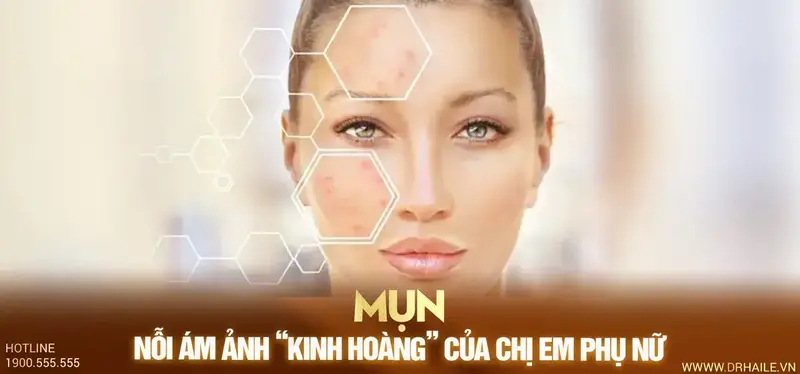 “Mụn” – nỗi ám ảnh “kinh hoàng” của chị em phụ nữ.