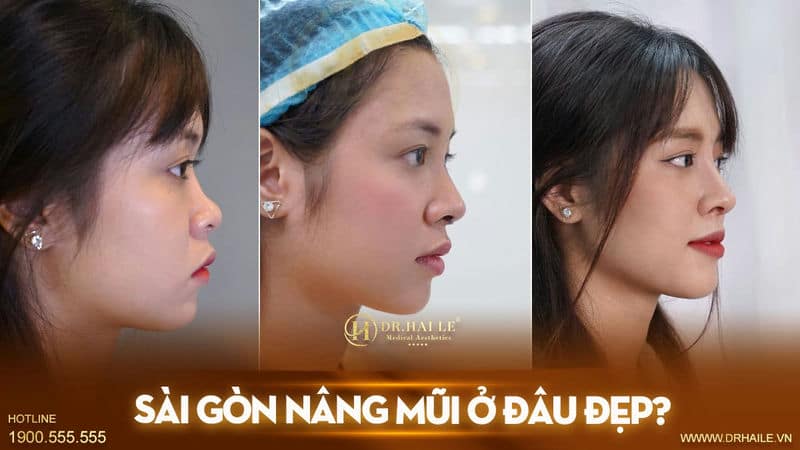 Sài Gòn nâng mũi ở đâu đẹp?