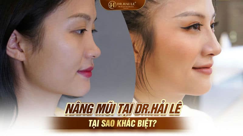 Nâng mũi tại Dr.Hải Lê tại sao khác biệt?