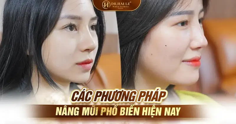 Các phương pháp nâng mũi phổ biến hiện nay