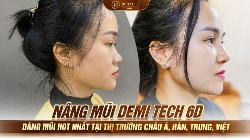 Nâng mũi Demi Tech 6D - Dáng mũi hot nhất tại thị trường châu Á, Hàn, Trung, Việt