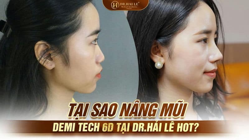 Tại sao Nâng mũi Demi Tech 6D tại Dr.Hải Lê hot?