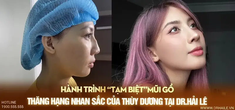 Hành trình “tạm biệt”mũi gồ, thăng hạng nhan sắc của Thùy Dương tại Dr.Hải Lê Hành trình “tạm biệt”mũi gồ, thăng hạng nhan sắc của Thùy Dương tại Dr.Hải Lê