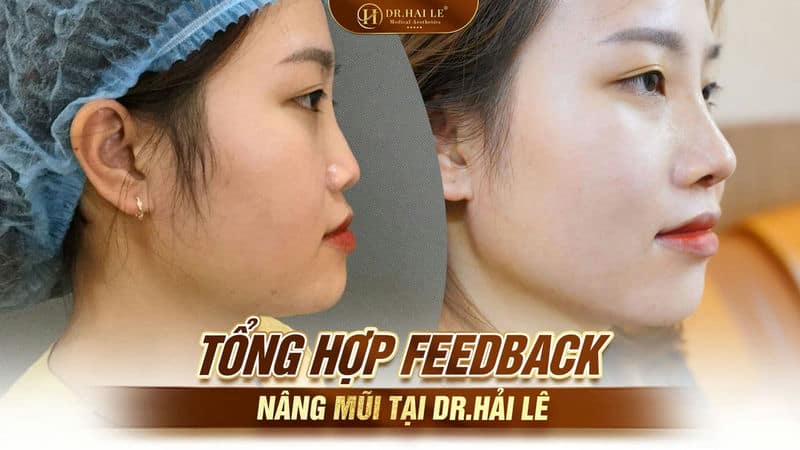 Tổng hợp feedback nâng mũi tại Dr.Hải Lê
