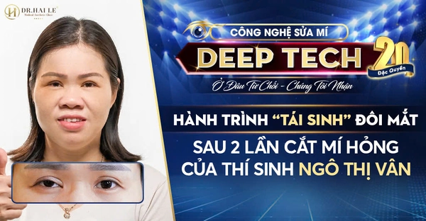 Hành Trình “Tái Sinh” Đôi Mắt Sau 2 Lần Cắt Mí Hỏng Của Thí Sinh Ngô Thị Vân Hành Trình “Tái Sinh” Đôi Mắt Sau 2 Lần Cắt Mí Hỏng Của Thí Sinh Ngô Thị Vân