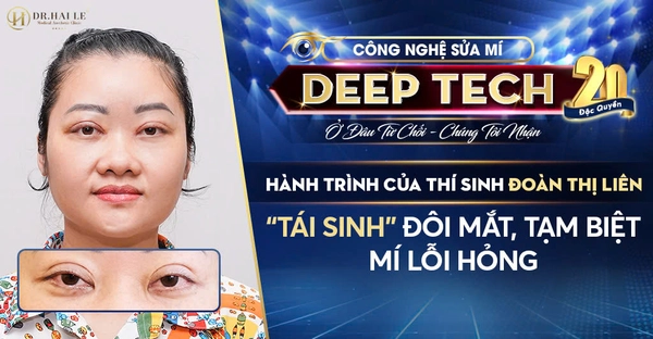 Hành Trình Của Thí Sinh Đoàn Thị Liên: Tái Sinh Đôi Mắt, Tạm Biệt Mí Lỗi Hỏng Hành Trình Của Thí Sinh Đoàn Thị Liên: Tái Sinh Đôi Mắt, Tạm Biệt Mí Lỗi Hỏng