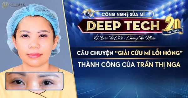 Câu Chuyện “Giải Cứu Mí Lỗi Hỏng” Thành Công Của Trần Thị Nga Câu Chuyện “Giải Cứu Mí Lỗi Hỏng” Thành Công Của Trần Thị Nga