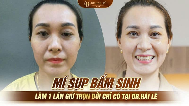 Mí sụp bẩm sinh làm 1 lần giữ trọn đời chỉ có tại Dr.Hải Lê
