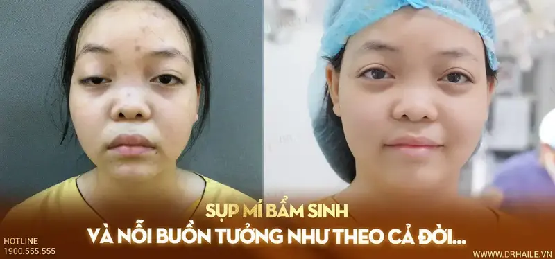 Sụp mí bẩm sinh và nỗi buồn tưởng như theo cả đời...