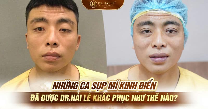 Những ca sụp mí kinh điển đã được Dr.Hải Lê khắc phục như thế nào?