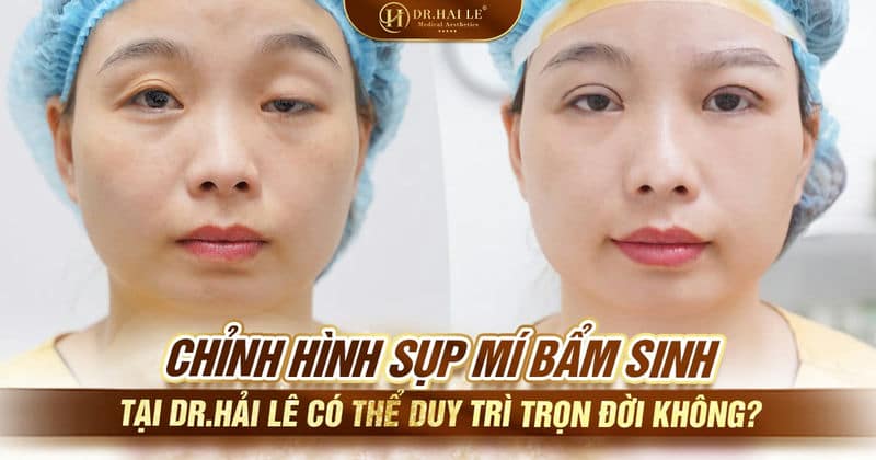 Chỉnh hình sụp mí bẩm sinh tại Dr.Hải Lê có thể duy trì trọn đời không?