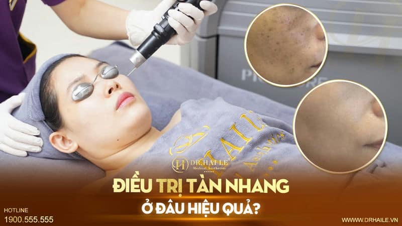 Điều trị tàn nhang ở đâu hiệu quả?