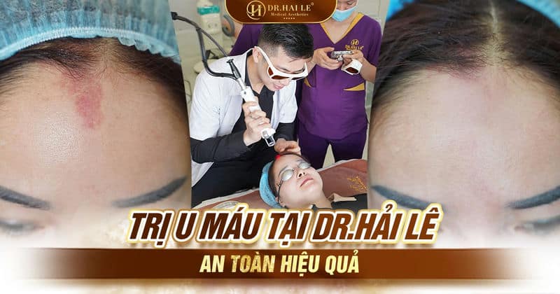 Trị u máu tại Dr.Hải Lê an toàn hiệu quả