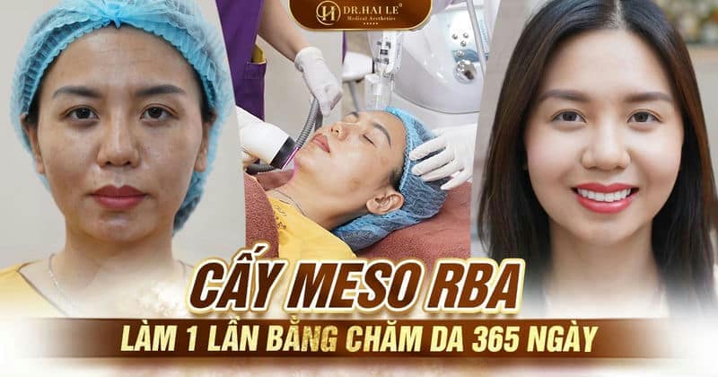 Cấy Meso - RBA - làm 1 lần bằng chăm da 365 ngày