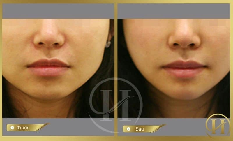ảnh khách hàng khi độn cằm V-line tại Dr.Hải Lê