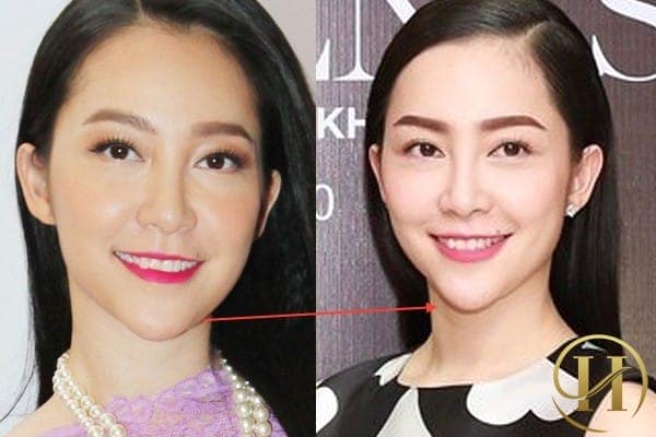 Nghi án độn cằm của "chân dài làng múa" Linh Nga