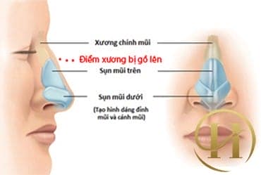 Phẫu thuật sữa mũi gồ