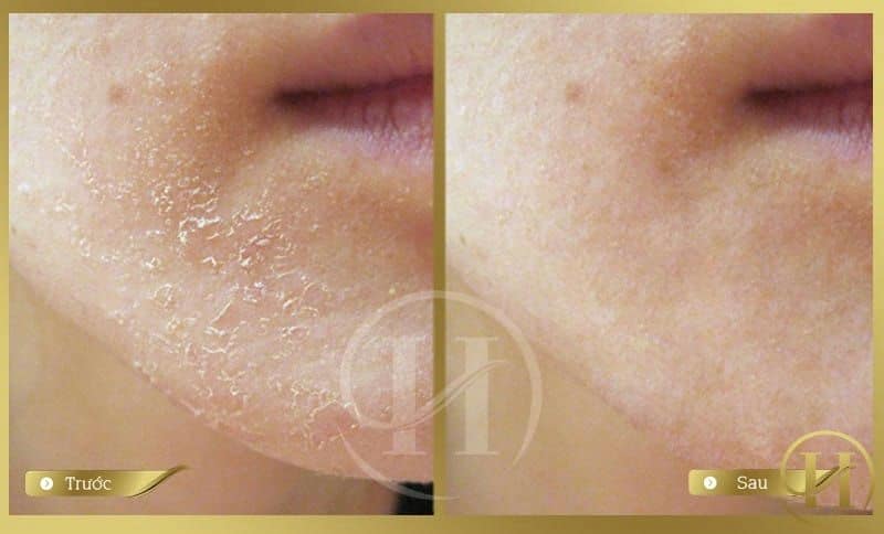 Trị da khô bằng công nghệ Vital injector tại Dr.Hải Lê